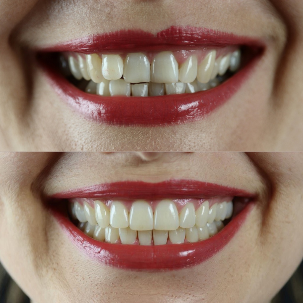 Perfect Teeth - Free AI Image Enhancement